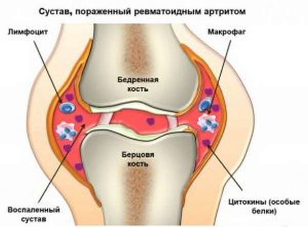 Операция по удалению кисты в коленном суставе